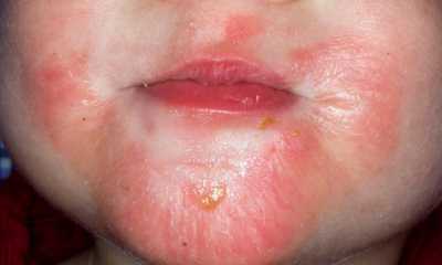 Аллергический дерматит у грудничков