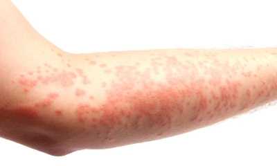 Аллергический дерматит