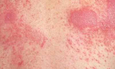 Как выглядит аллергический дерматит