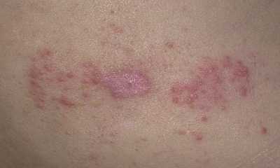 Аллергический контактный дерматит