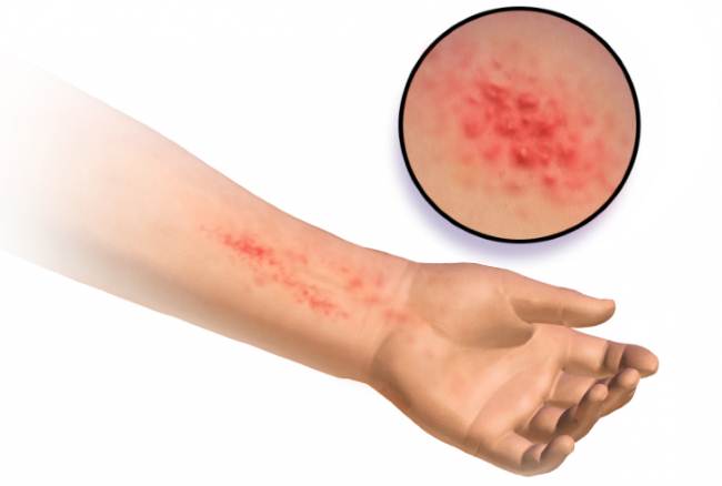 Как выглядит контактный дерматит