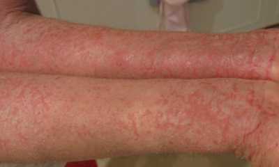 Контактный дерматит на руках