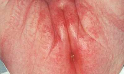 Памперсный дерматит