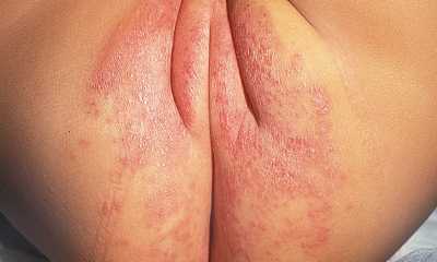 Пеленочный кандидозный дерматит