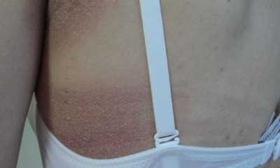 Простой контактный дерматит