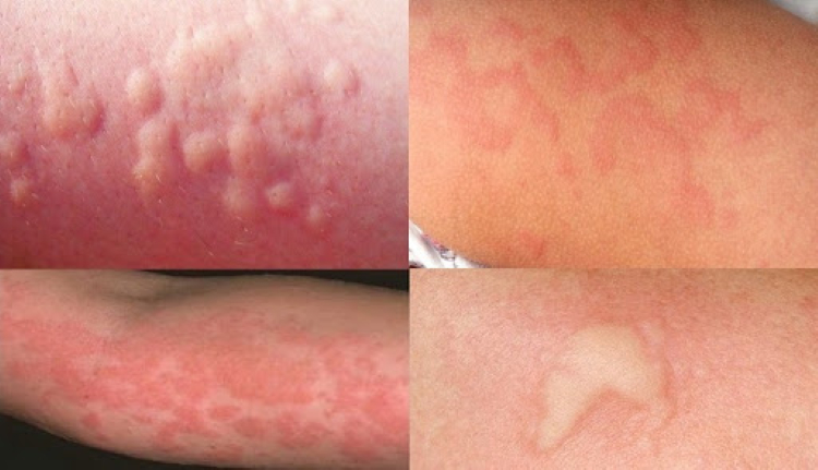 Аллергия на теле