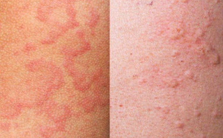 Сыпь при аллергии