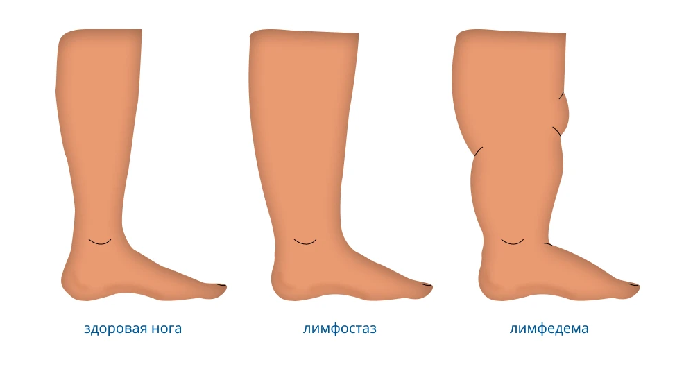 Как выглядит лимфостаз