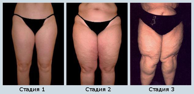 Лимфостаз нижних конечностей