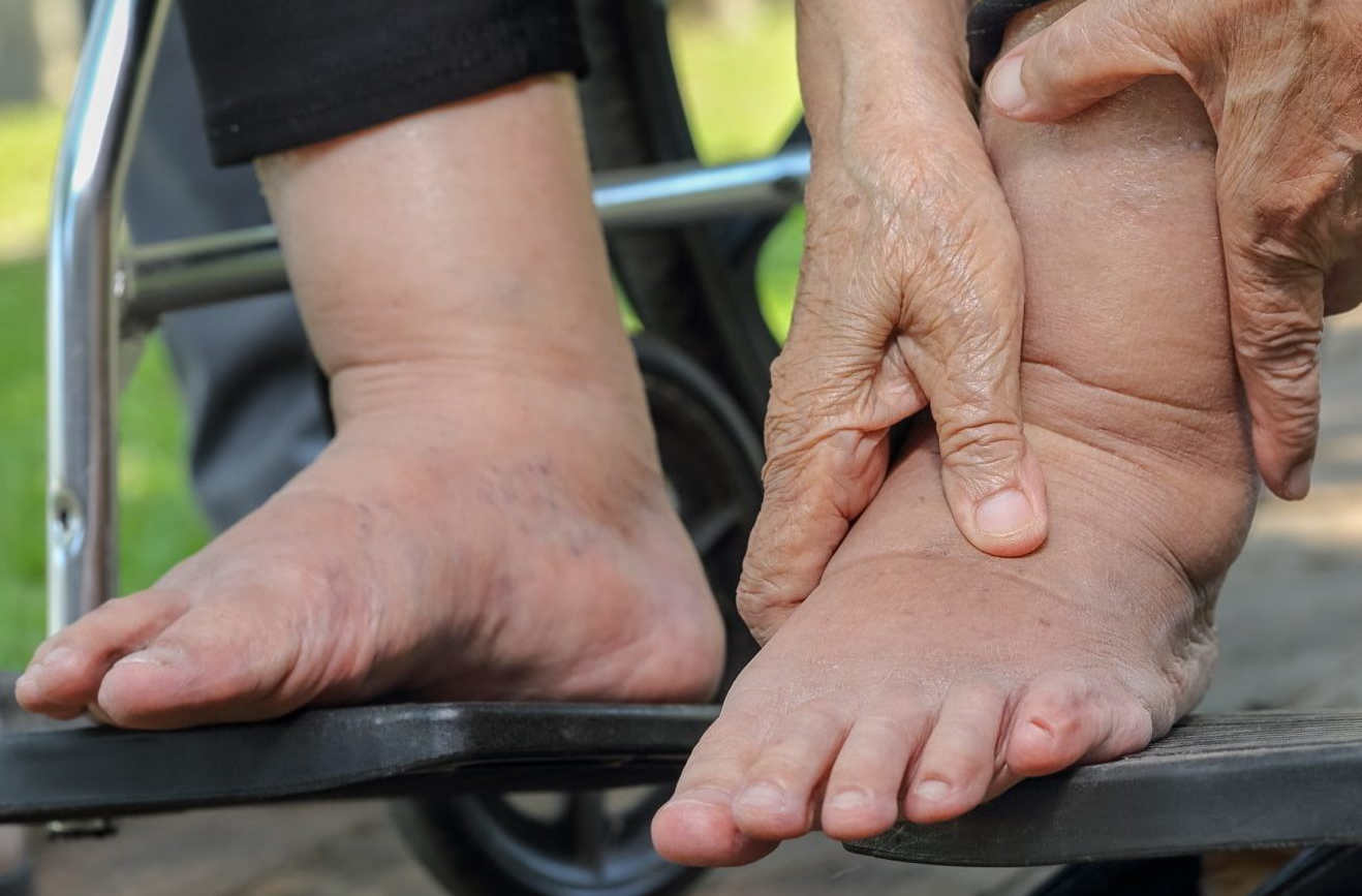 Лимфостаз ног