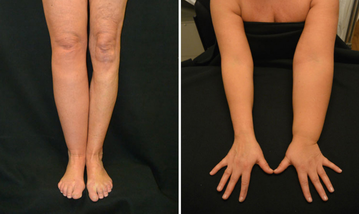 Лимфостаз руки