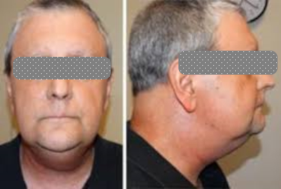 Лимфостаз шеи