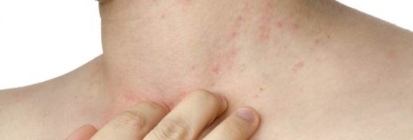 Как выглядит дерматит у взрослых