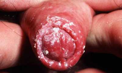 Инфекция кандидоза у мужчин фото thumbnail