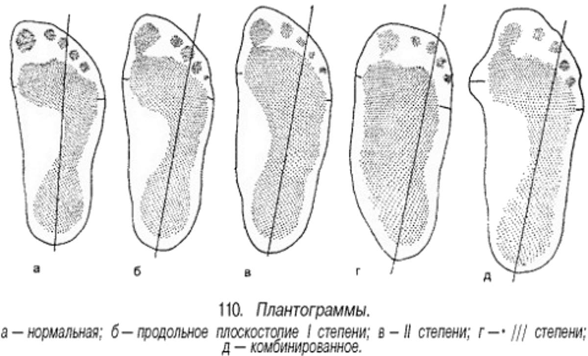 Продольное изображение. Плантография поперечного плоскостопия. Измерение степени продольного плоскостопия рис. Плантограмма при поперечном плоскостопии. Поперечное плоскостопие отпечаток.