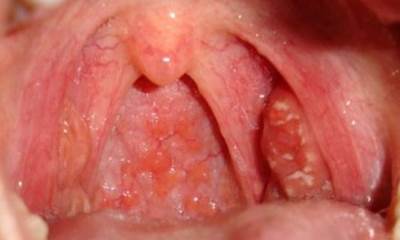 Сыпь в горле симптомы фото thumbnail