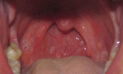 Вирусная сыпь в горле фото thumbnail