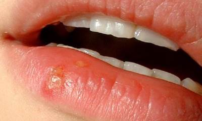 Сифилитический шанкр на губе фото