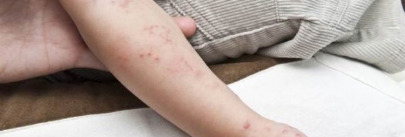 Герпес на руках