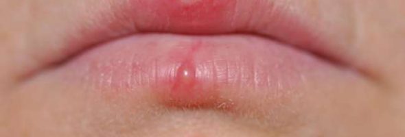 Как выглядит простуда