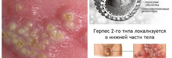 Генитальный герпес