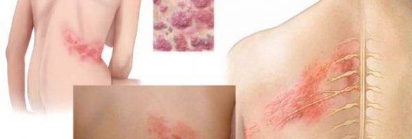 Опоясывающий герпес