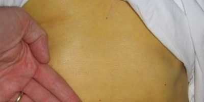 Как выглядит гепатит