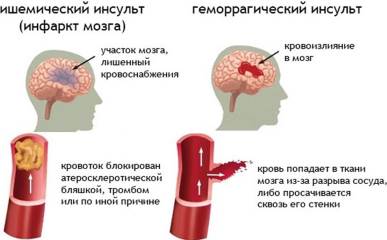 Головной мозг инсульт картинки thumbnail