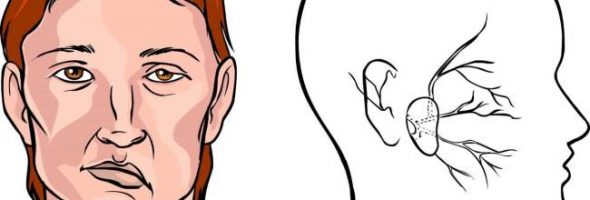 Инсульт у людей