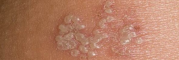 Герпес на ноге