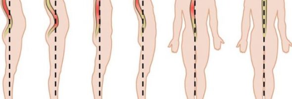 Искривление позвоночника