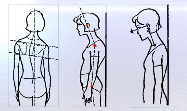 Лордотическая осанка фото