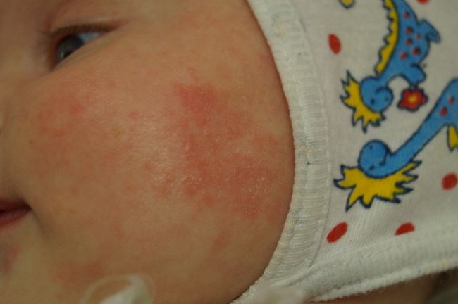 Дисбактериоз сыпь у ребенка фото thumbnail
