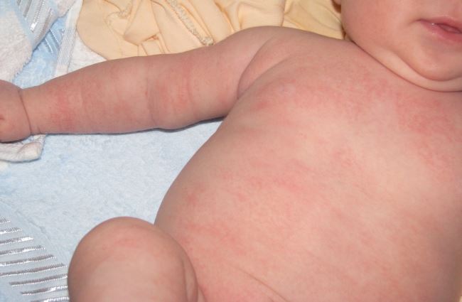 Может ли быть сыпь при дисбактериозе у ребенка до года thumbnail