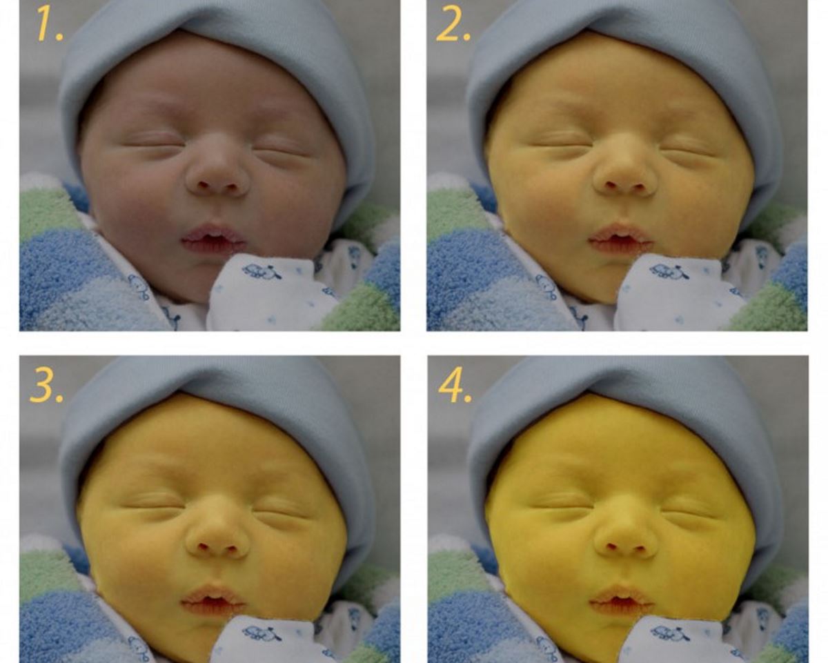 Фото желтушки у новорожденных до и после