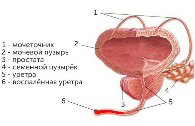 Фото с воспалением уретрита thumbnail