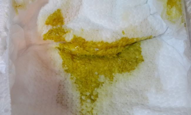 Как выглядит сыпь при дисбактериозе у ребенка thumbnail