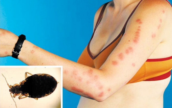 Аллергия на укусы насекомых фото thumbnail