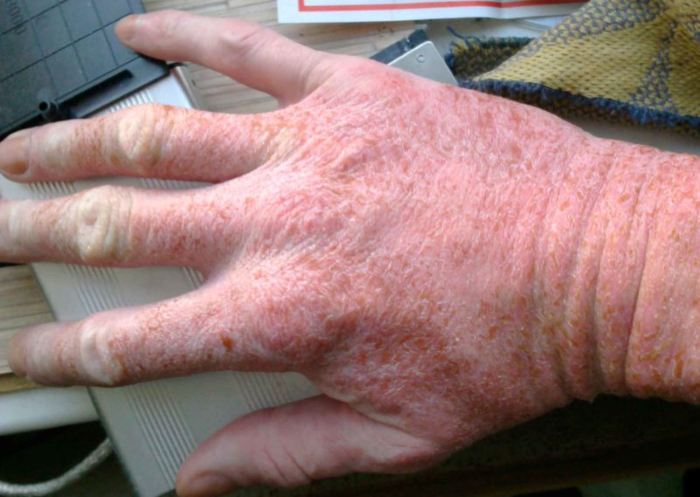 Аллергия на мороз на руках