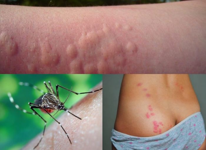 Аллергия на укусы комаров