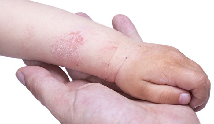 Лечение аллергии на холод у детей фото thumbnail