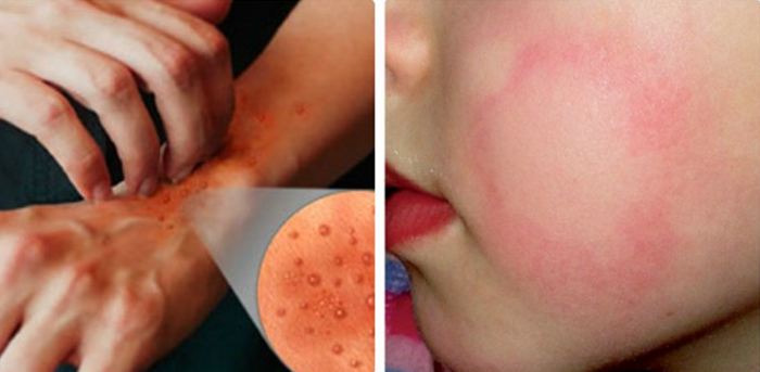 Холодовая аллергия на лице у детей фото thumbnail