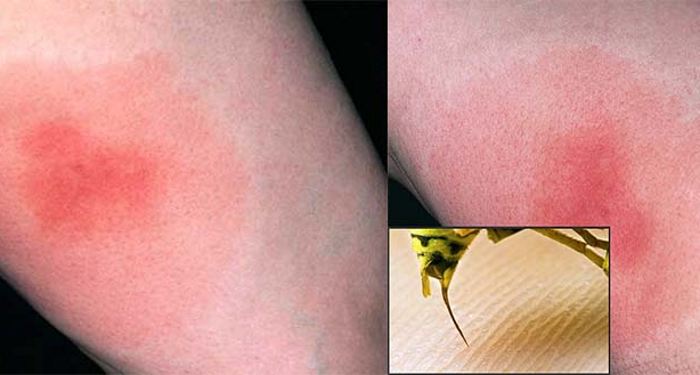 Как проявляется аллергия на укусы насекомых фото thumbnail
