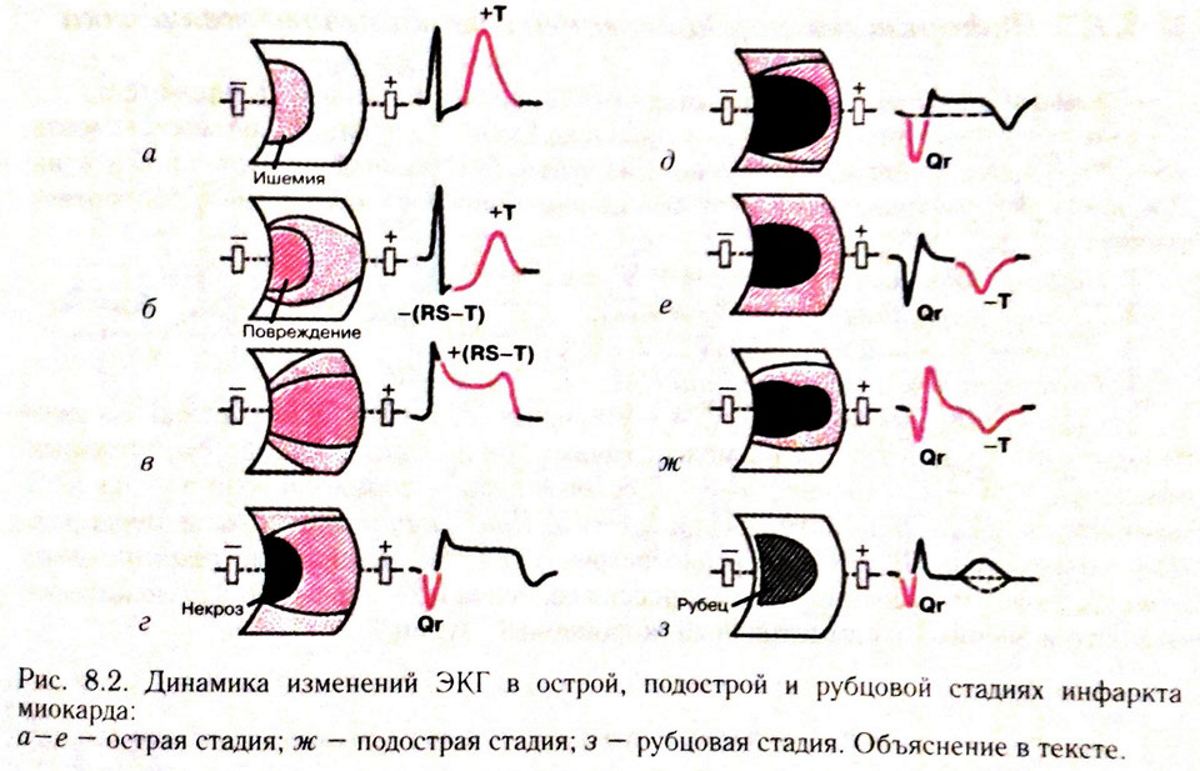 Экг при инфаркте миокарда. Острая стадия инфаркта ЭКГ изменения. ЭКГ при острейшей стадии инфаркта миокарда. Крупноочаговый инфаркт миокарда на ЭКГ. ЭКГ инфаркт миокарда остроподострая стадия.