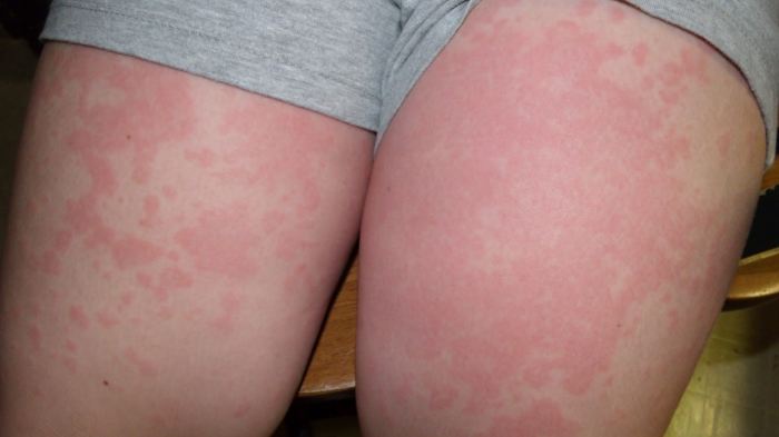 Холодовая аллергия на ногах