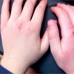 Аллергия на холод на коже у детей и взрослых: бывает ли, что делать, как лечить, фото