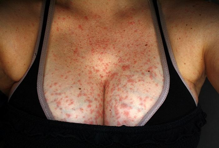 Аллергия на цитрусовые у взрослых фото thumbnail