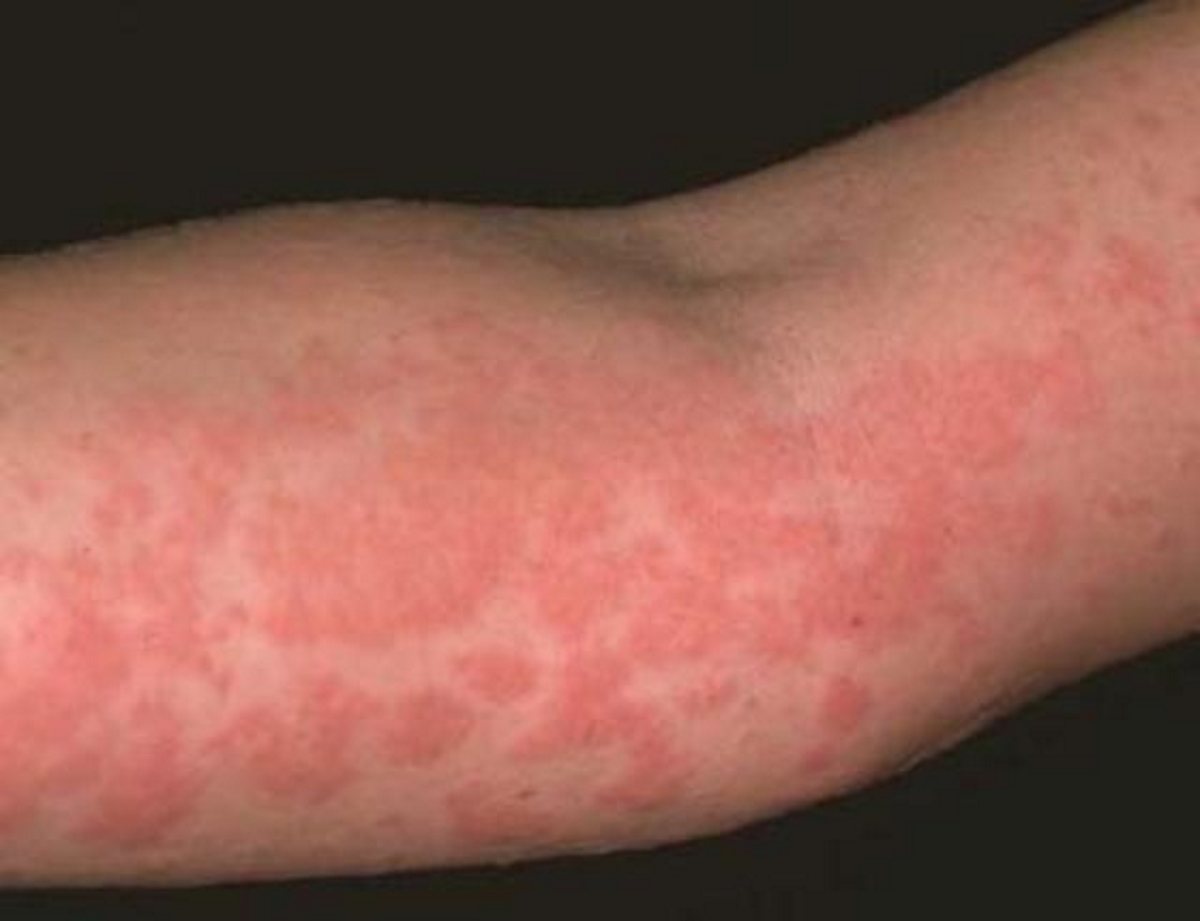 Kак выглядит аллергия на мороз | Галерея фото заболеваний