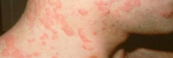 Аллергия на мороз