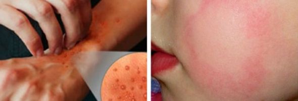 Как выглядит аллергия на холод